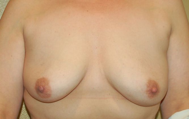 Breast Augmentation w/ Lift Case 237 - Before