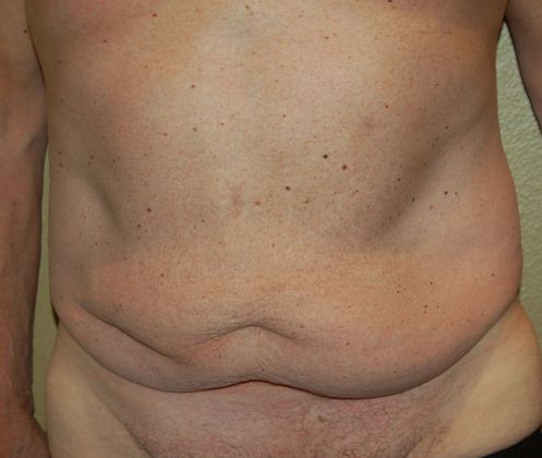 Massive Weight Loss  Case 46 - Before