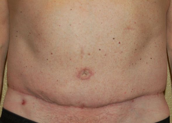 Massive Weight Loss  Case 46 - After