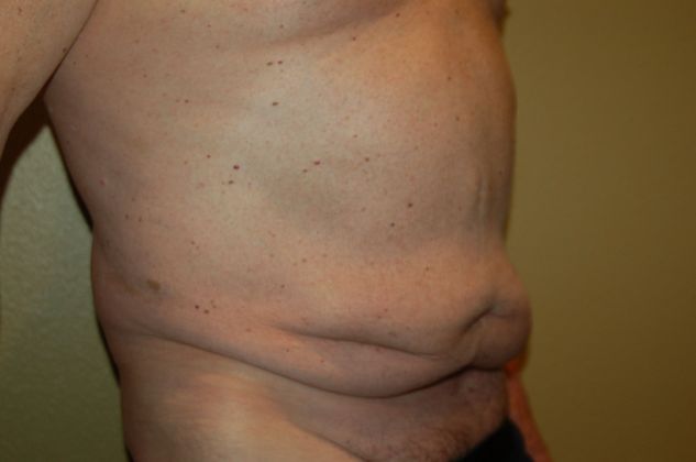 Massive Weight Loss : Case 46 - Before