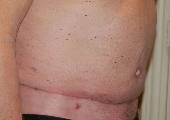 Massive Weight Loss : Case 46 - After