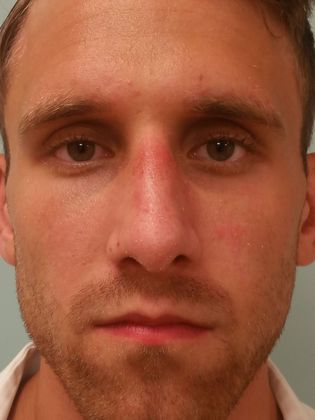 Rhinoplasty: Case 9 - Rhinoplasty, Norwalk - After