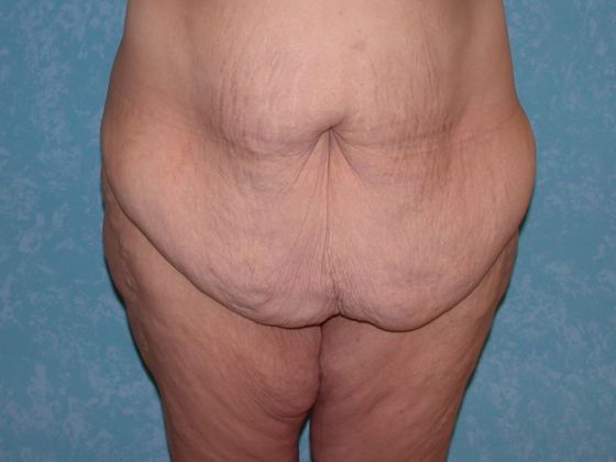 Bodylift C1523 - Elmore, OH - Before