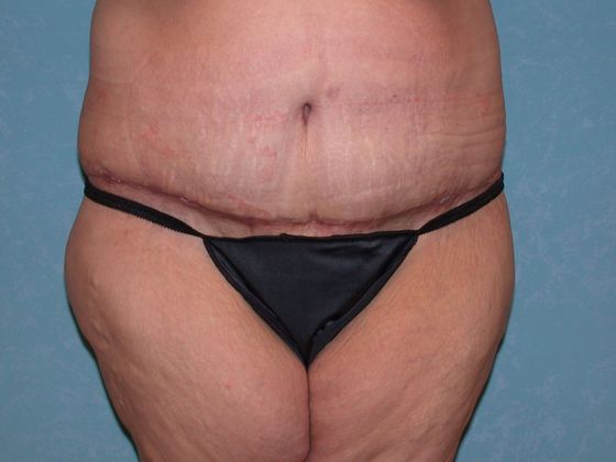 Bodylift C1523 - Elmore, OH - After