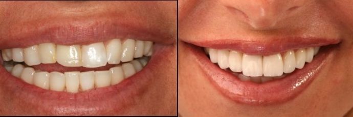 Case 2 Smile Makeovers Before And After Gallery