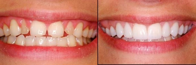 Case 3 Smile Makeovers Before And After Gallery