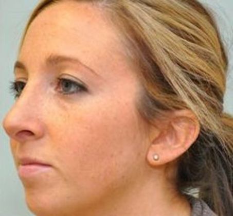 Rhinoplasty: Case 2 - Rhinoplasty, Stratford - After
