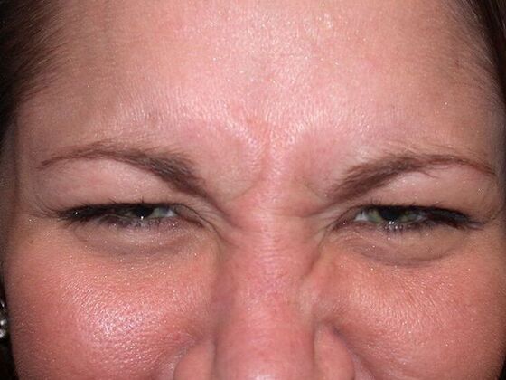 Botox® and Fillers BX1614 - Maumee, OH - Before