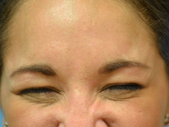 Botox® and Fillers BX1614 - Maumee, OH - After