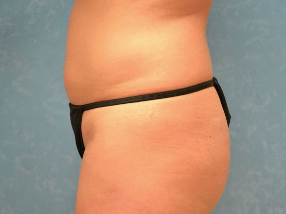 Coolsculpt: CS1605 - Bowling Green, OH - Before