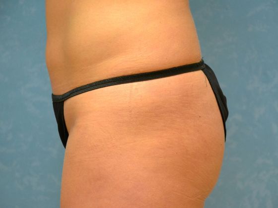 Coolsculpt: CS1605 - Bowling Green, OH - After