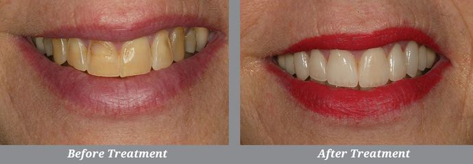 Smile Makeover Case 2: Malverne, NY