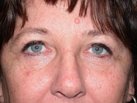 Eye Lift (Blepharoplasty) ULB1466 - Toledo Oh - After