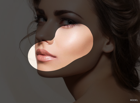 Injectable Fillers (Juvederm/Restylane) Cases