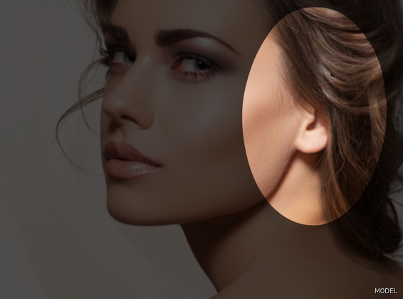 Otoplasty (Ear pinning) Cases