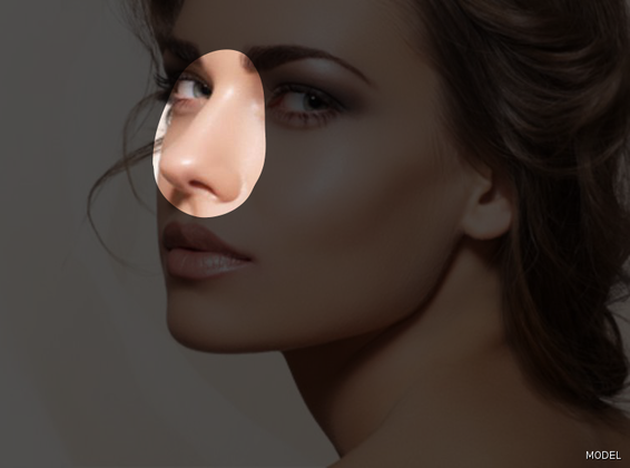 Nose Reshaping (Rhinoplasty) Cases