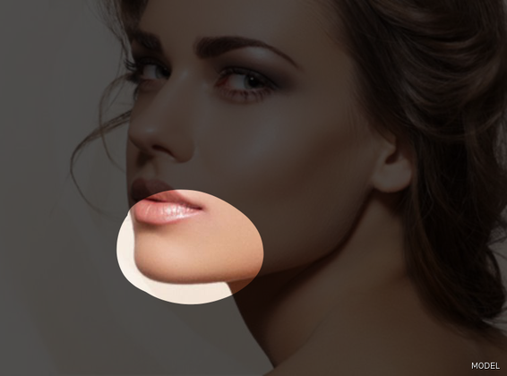 Chin Augmentation Cases