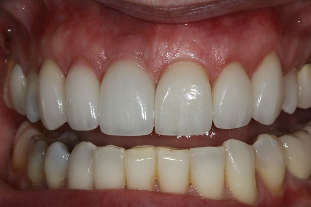 Lynn - Implant Retained Crowns - Before and After Gallery