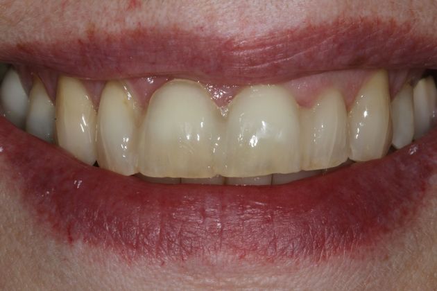 Implant Retained Crowns: Lynn - Before