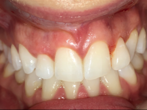 Porcelain Veneers: Case 17 - Before