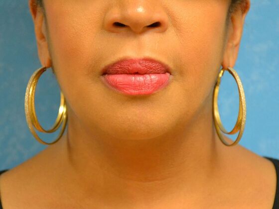 Kybella KB1601 - Millbury, OH - After