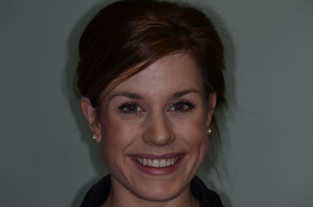 Porcelain Veneers: Case 4 - Before smile