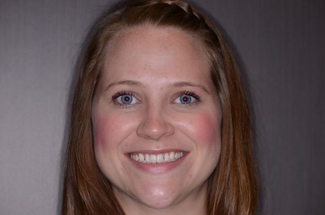 Porcelain Veneers: Case 6 - before smile design and veneers