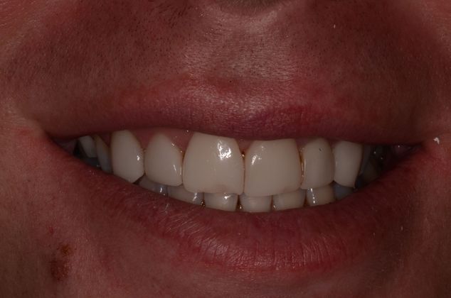 Porcelain Veneers: Case 13 - Before veneer replacement