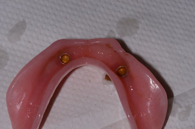 Dentures: Case 2 - locators, implant supported dentures