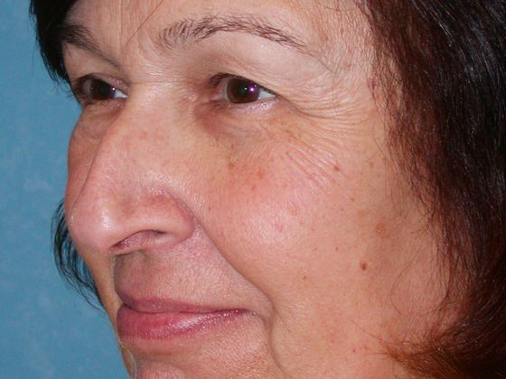 Rhinoplasty RP0714 - Sylvania, OH - Before