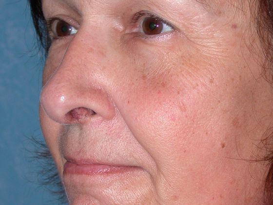 Rhinoplasty RP0714 - Sylvania, OH - After