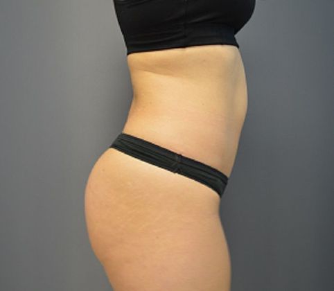 Tummy Tuck Case 2 - After