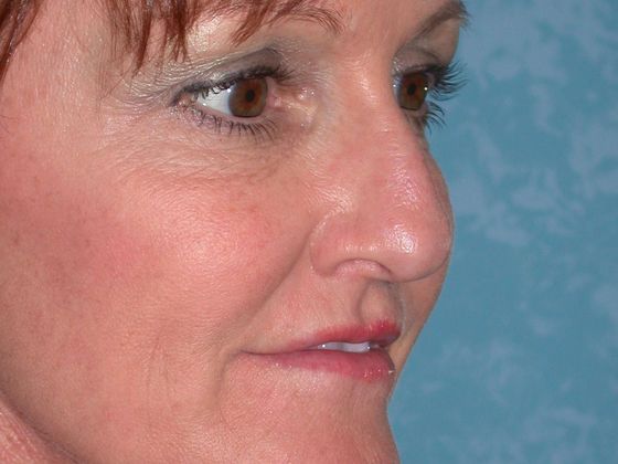 Rhinoplasty RP1109 - Van Wert, OH - Before