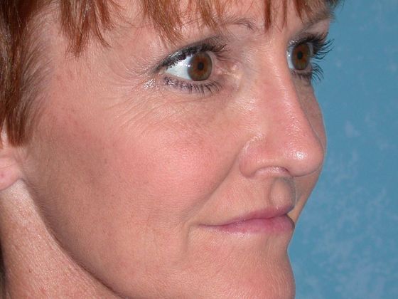 Rhinoplasty RP1109 - Van Wert, OH - After