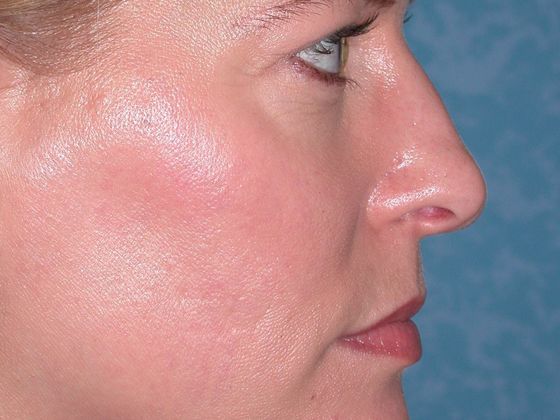 Rhinoplasty RP0719 - Tiffin, OH - Before