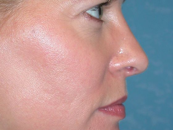 Rhinoplasty RP0719 - Tiffin, OH - After