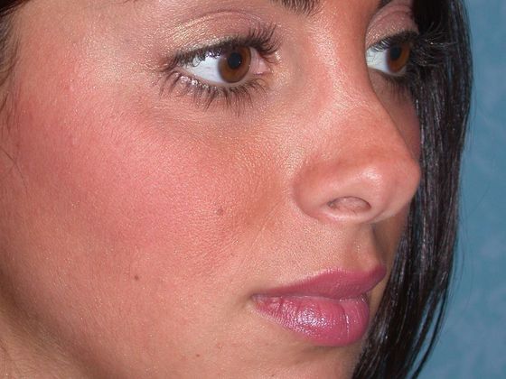 Rhinoplasty RP0544 - Perrysburg, OH - Before