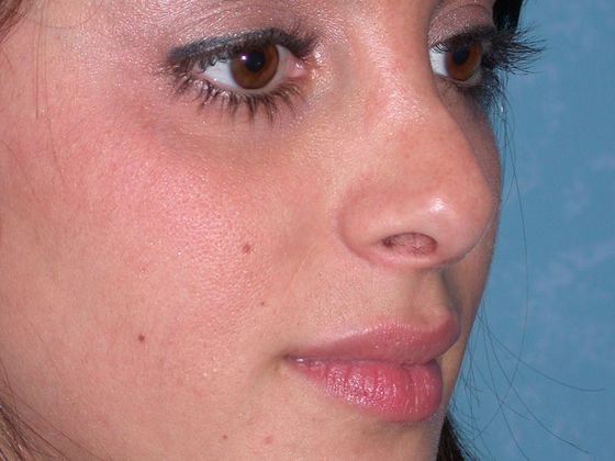 Rhinoplasty RP0544 - Perrysburg, OH - After