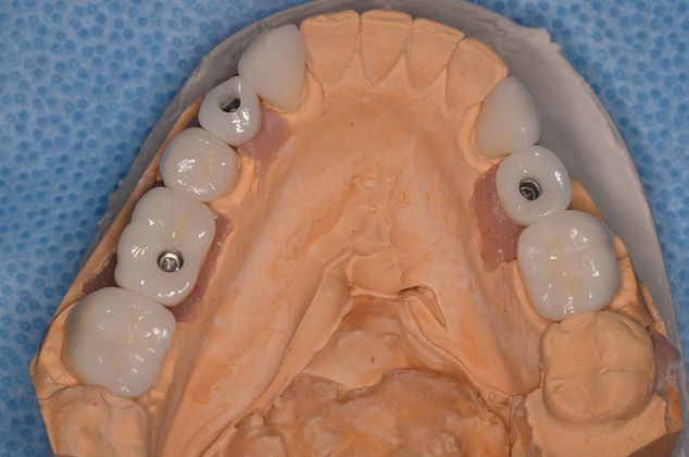 Dental Implants Case 19 - Before