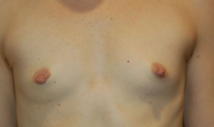 Breast Augmentation Case 469 - Before