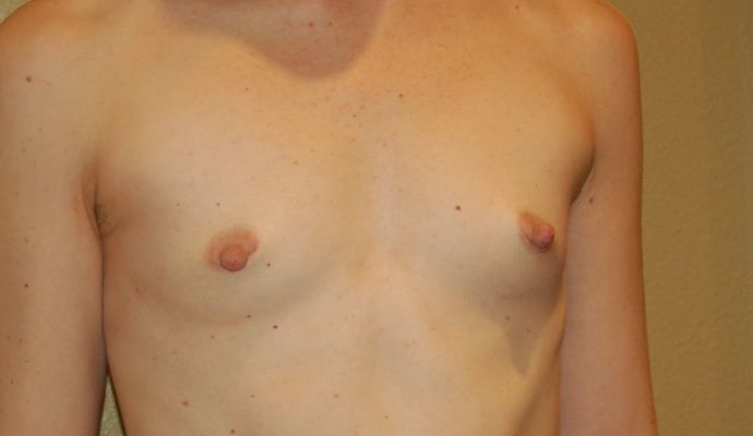 Breast Augmentation: Case 469 - Before
