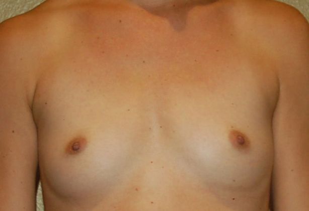 Breast Augmentation Case 476 - Before