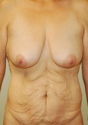 Mommy Makeover Case 101 - Before