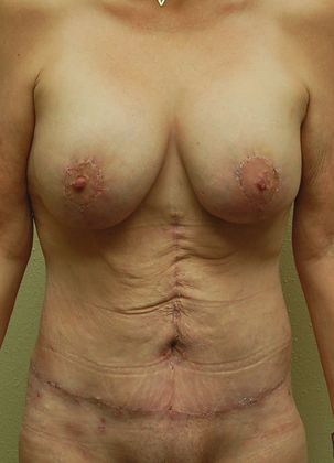 Mommy Makeover Case 101 - After