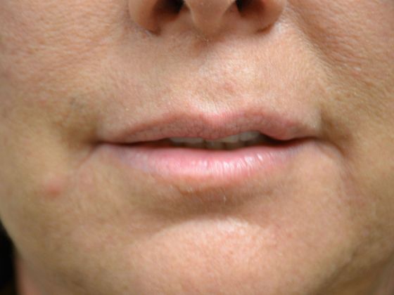Botox® and Fillers: JV1721 - Toledo, OH - Before
