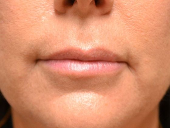 Botox® and Fillers: JV1721 - Toledo, OH - After