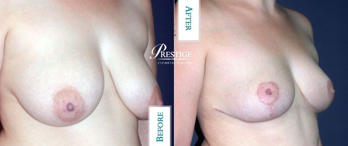 Breast Lift Case 4