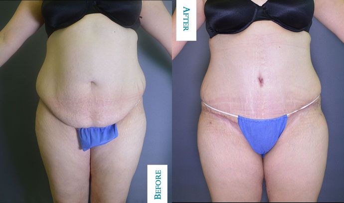Tummy Tuck: Case 3 - Before & After
