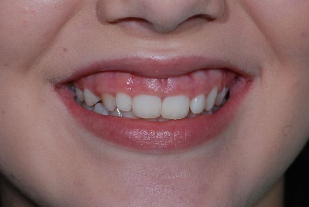 Crown Lengthening Esthetic Crown Lengthening Upper Front Teeth - Before