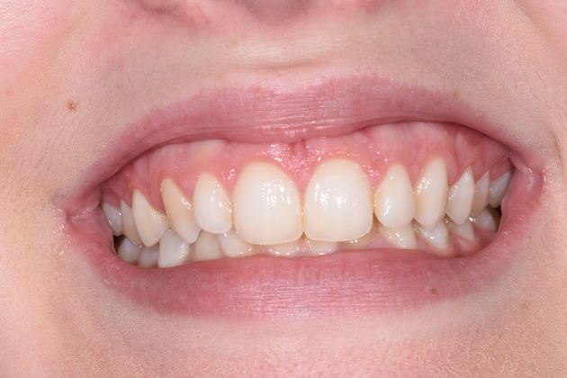 Crown Lengthening Esthetic Crown Lengthening Upper Front Teeth - After